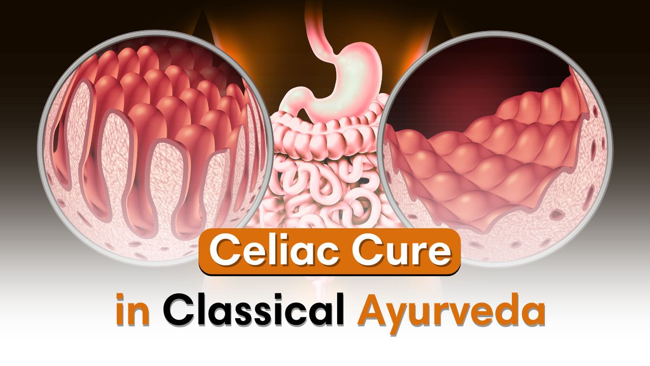 Celiac Disease in Ayurveda: A Classical Correlation & Deep Ayurveda’s Holistic Management