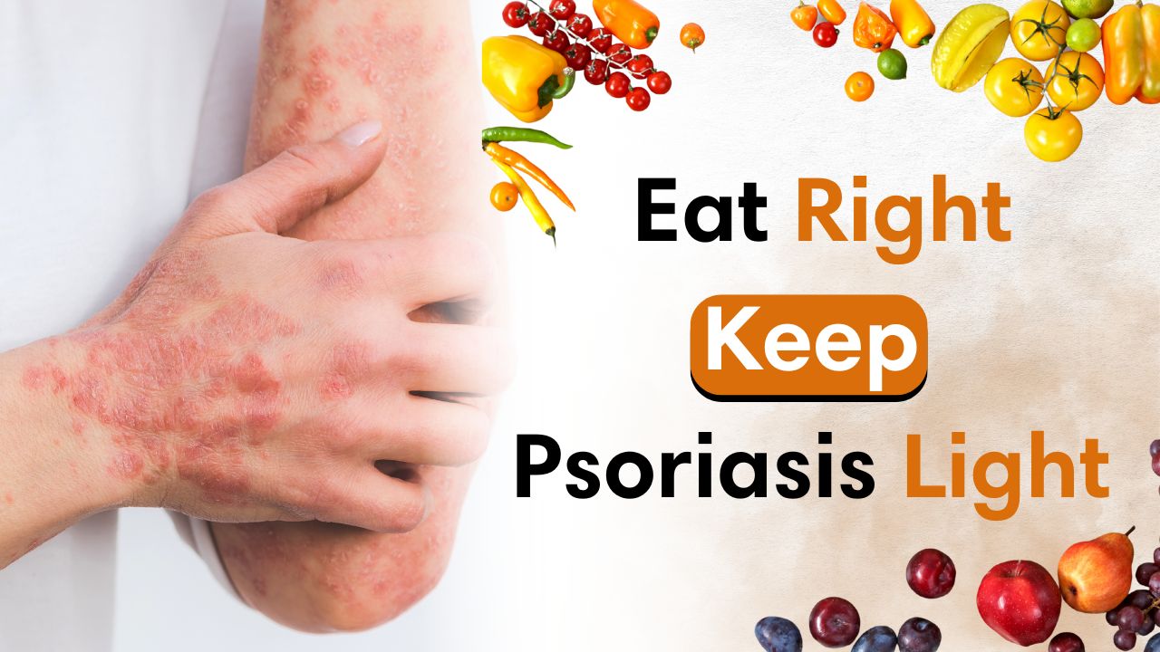 Foods to Avoid with Psoriasis for Better Skin Health