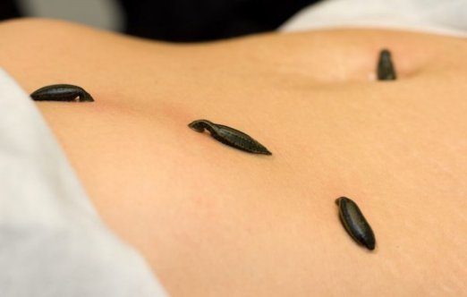 Raktamokshana Therapy