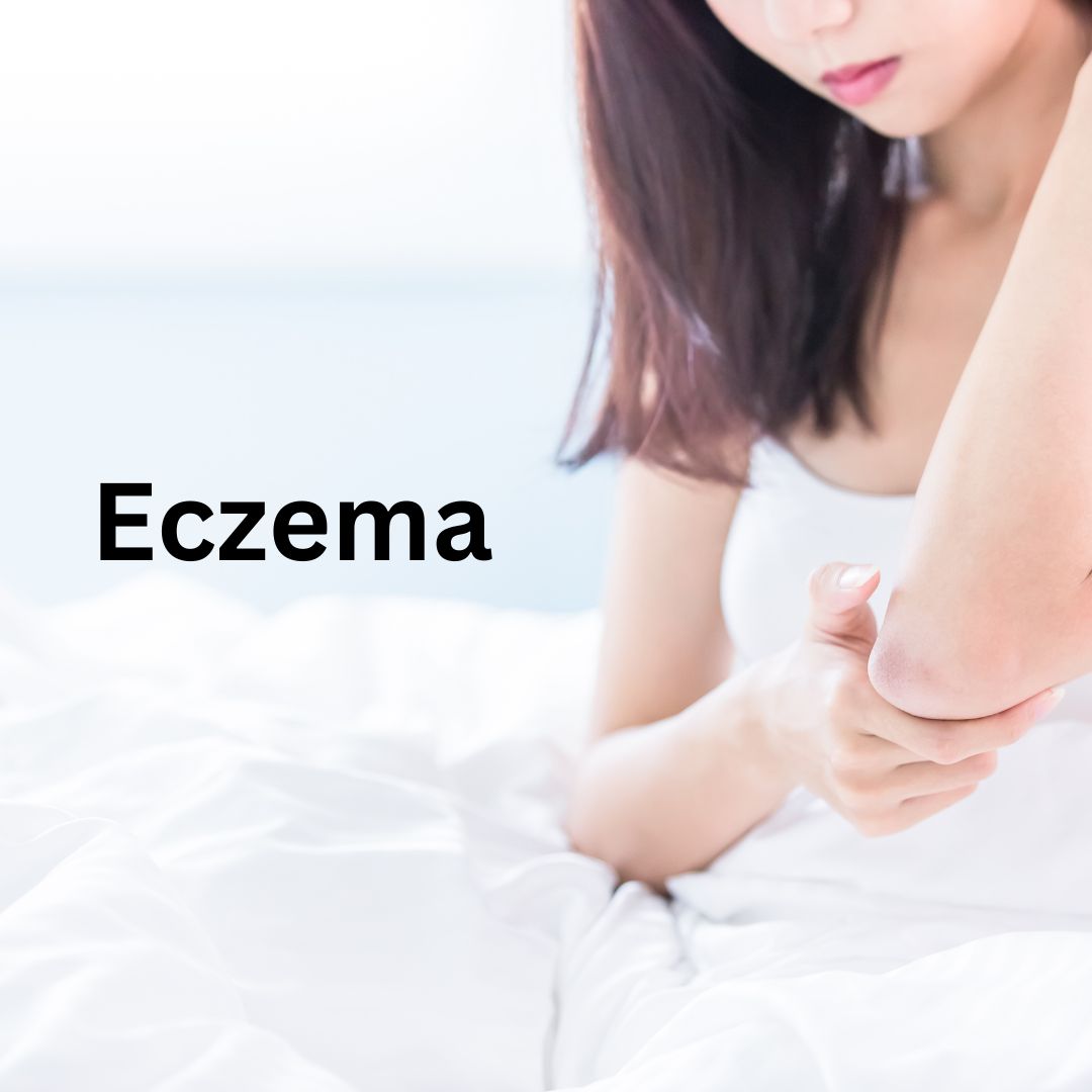eczema treatment in ayurveda