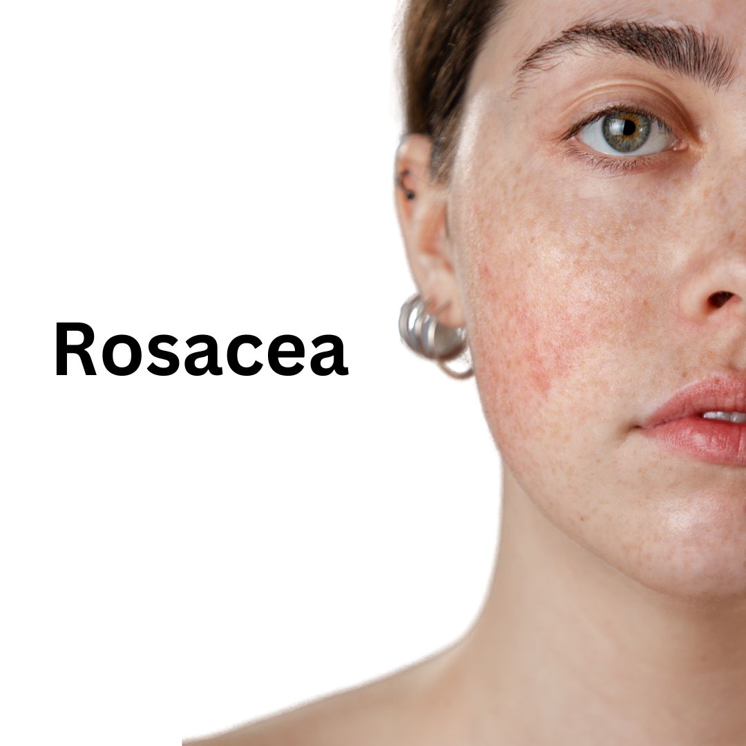 Rosacea treatment in ayurveda