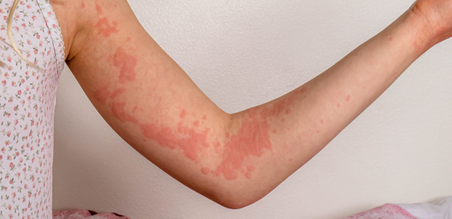 Ursodeoxycholic acid side effect
