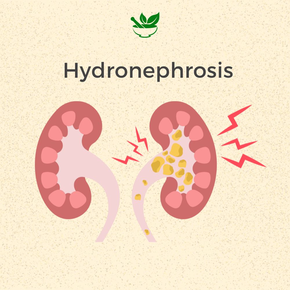 Hydronephrosis Ayurvedic Management 30 Days Pack