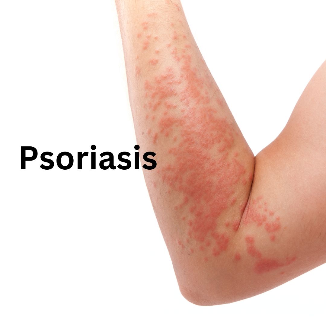 psoriasis treatment in ayurveda