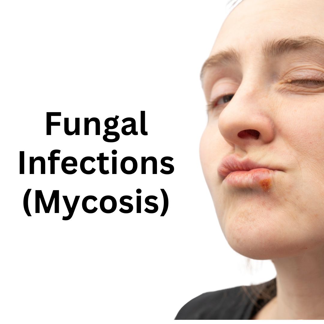 Fungal Infections (Mycosis) treatment in ayurveda