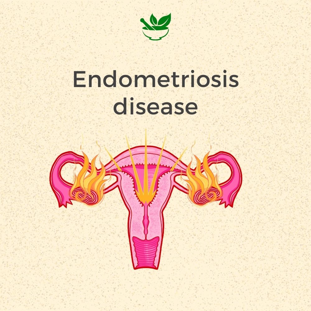Endometriosis Ayurvedic Management 30 Days Pack
