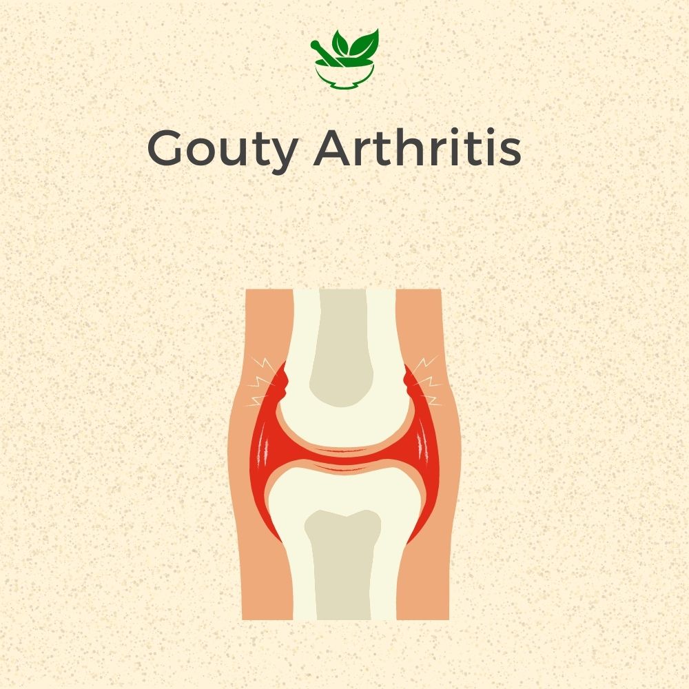 Gouty Arthritis Ayurvedic Management 30 Days Pack - Deep Ayurveda India