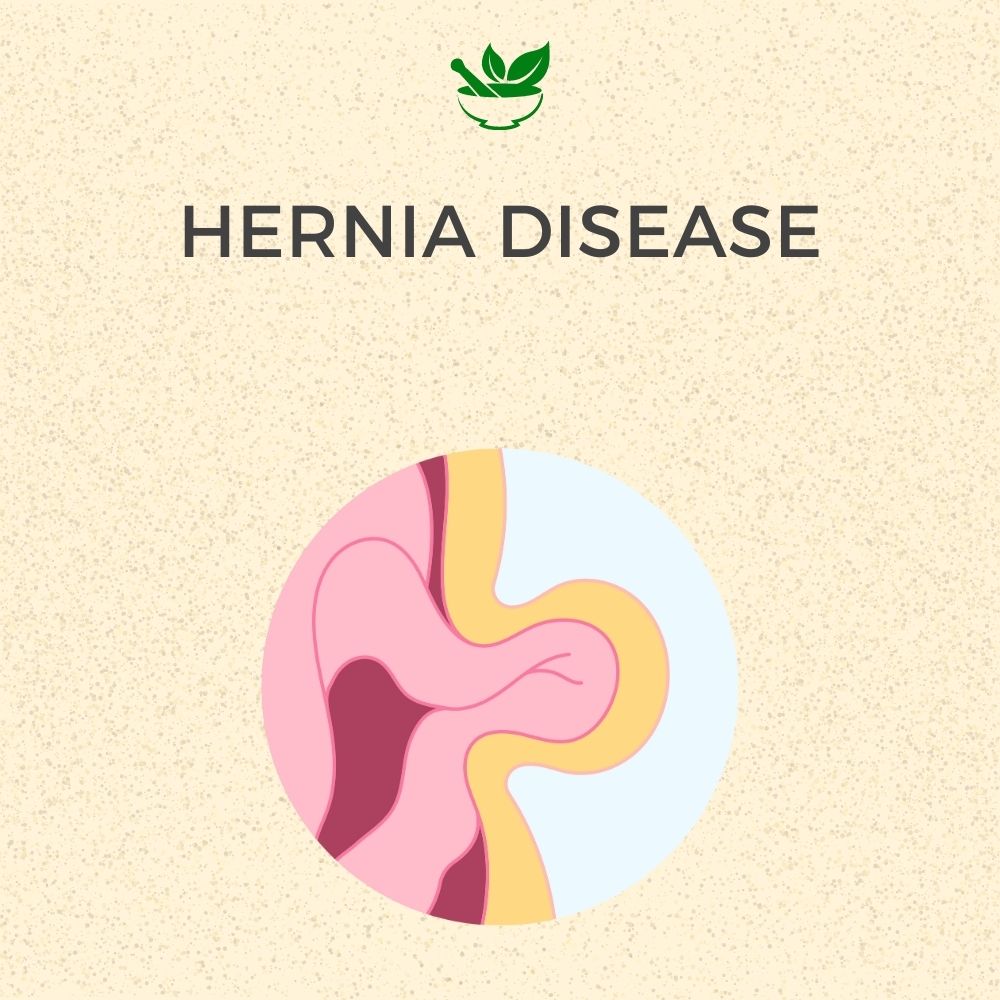 Hernia Ayurvedic Management 30 Days Pack - Deep Ayurveda India