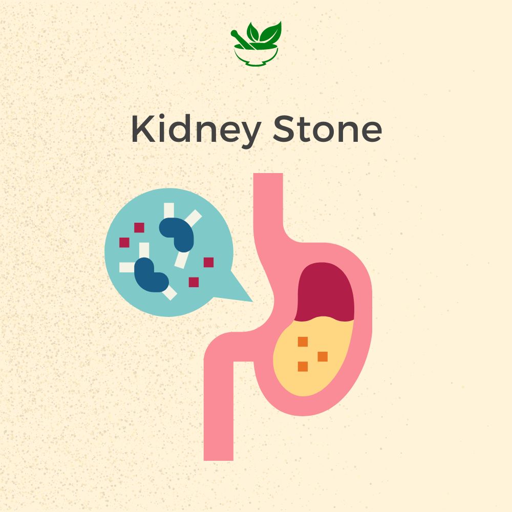 Kidney Stone Ayurvedic Management 30 Days Pack - Deep Ayurveda India