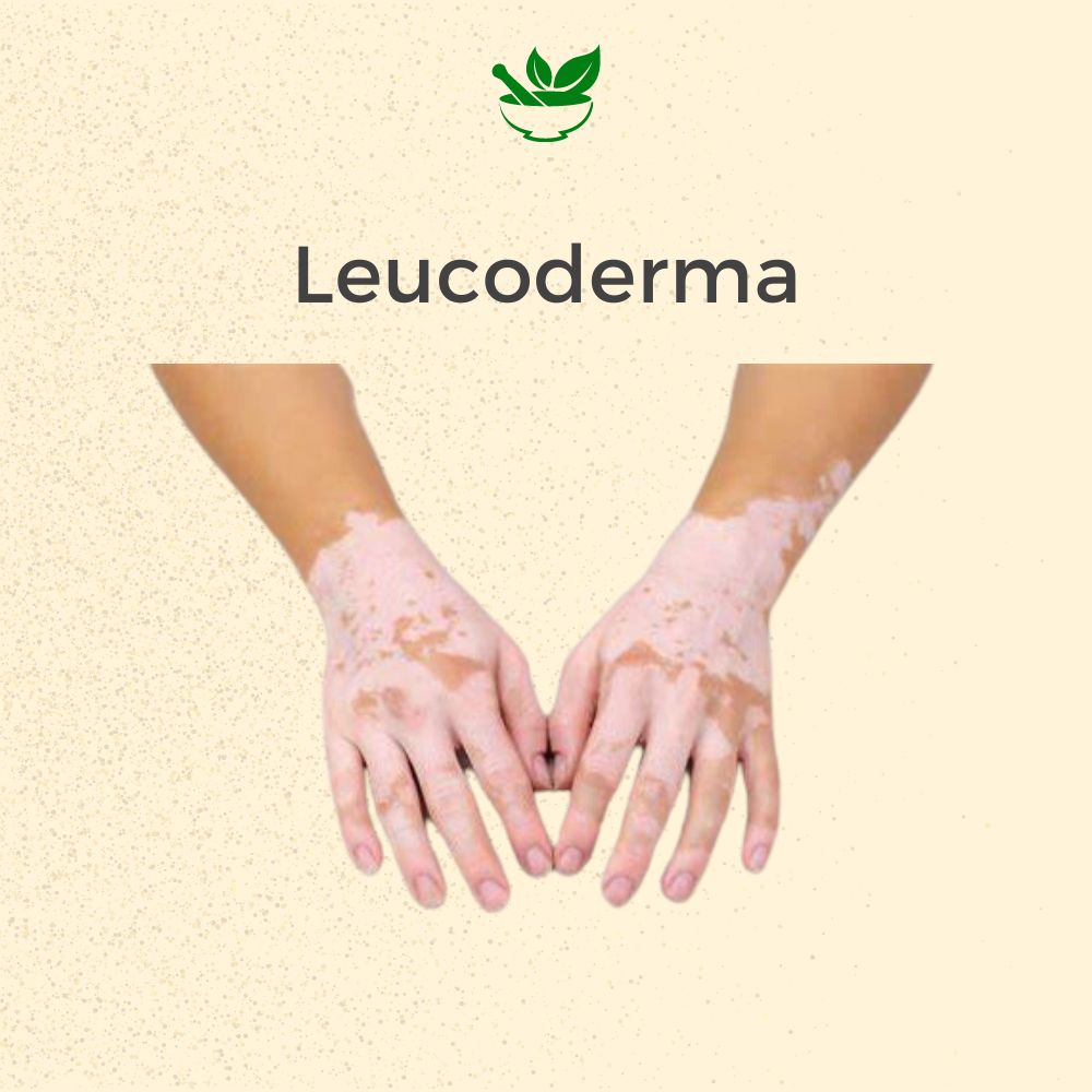 Leucoderma Ayurvedic Management 30 Days Pack - Deep Ayurveda India